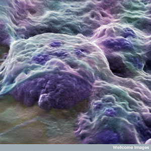 Эти эмбриональные стволовые клетки, полученные из человеческого эмбриона, могут превращаться в любой тип клеток. Но их трудно достать, и их нельзя использовать для непосредственного лечения БГ.