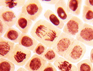 Рак возникает, когда клетки делятся неконтролируемым образом. Все больше мы понимаем, что это часто происходит из-за различий в нашей ДНК. Теперь похоже, что генетическая аномалия, вызывающая БГ, может быть связана с развитием рака.   