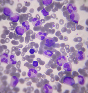 Лейкоциты (белые кровяные клетки) ответственны за защиту человека от патогенных микроорганизмов.  