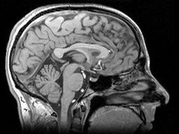 Молекулы белка гентингтина, содержащие слишком много глутамина, не могут собираться должным образом и образуют токсичные агрегаты, которые, как было показано, со временем накапливаются в головном мозге пациентов. Однако эти сгустки не видны при большинстве видов сканирования мозга, например, при МРТ.   